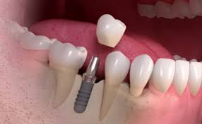 Svarbi informacija apie dantų implantaciją